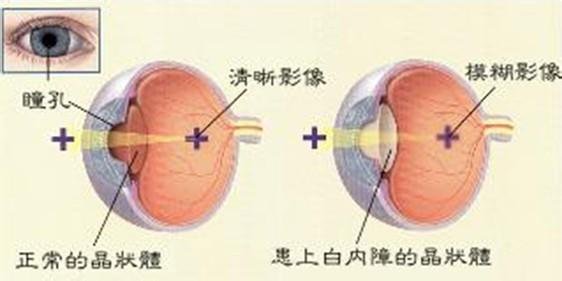 淺談白內(nèi)障的臨床表現(xiàn)