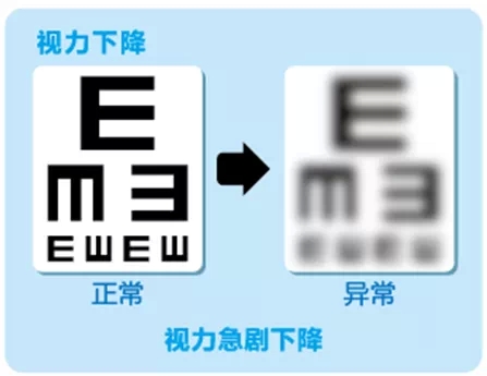 視網(wǎng)膜脫離啥癥狀？這張圖告訴你！