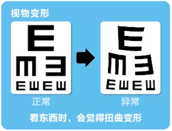 視網(wǎng)膜脫離啥癥狀？這張圖告訴你！