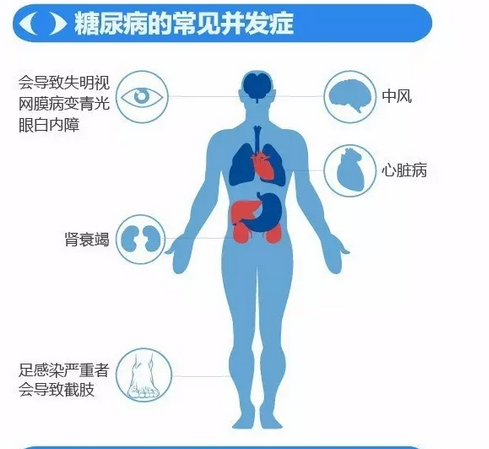 你造嗎？糖尿病晚期眼睛會致盲！