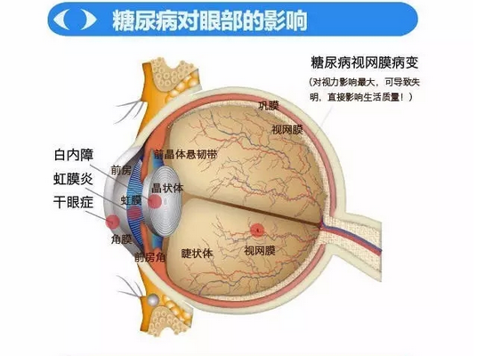 你造嗎？糖尿病晚期眼睛會致盲！