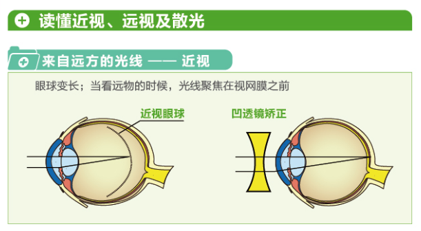 【看圖解】一張圖教你看懂近視、遠(yuǎn)視和散光