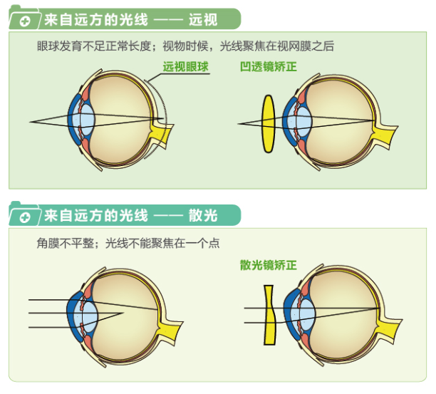 【看圖解】一張圖教你看懂近視、遠(yuǎn)視和散光