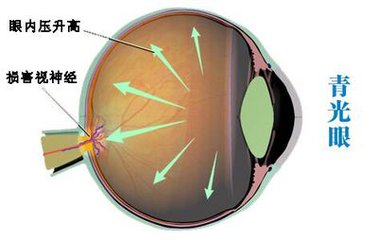 【詳解】誘發(fā)青光眼的原因