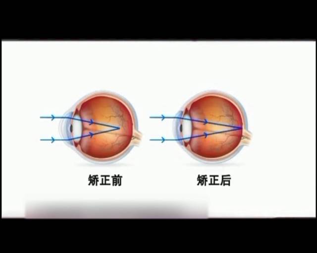 一夜之間真的能改變視力嗎？