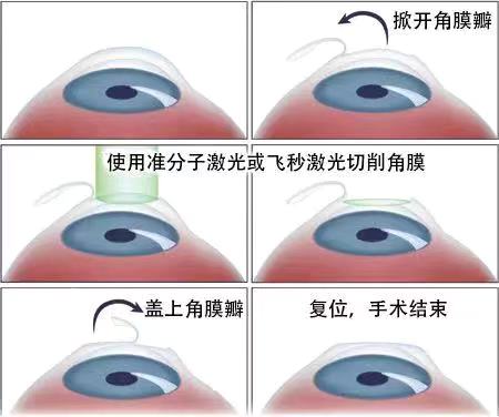 如果眼睛近視了該怎么？