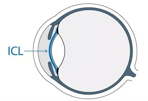 想做ICL晶體植入術(shù)，你需要了解的全在這里!